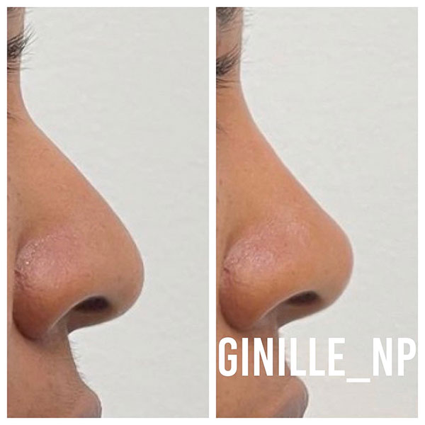 nonsurgical-nose-2-1