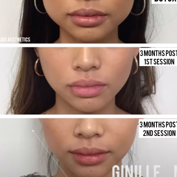 botox treatment for tmj in Los Angeles