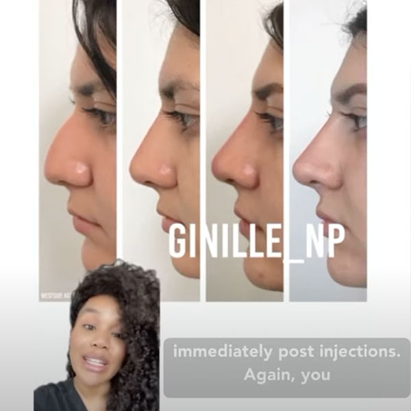 nose filler in Los Angeles