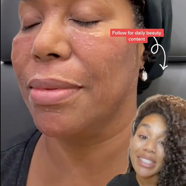 skinpen microneedling in Los Angeles