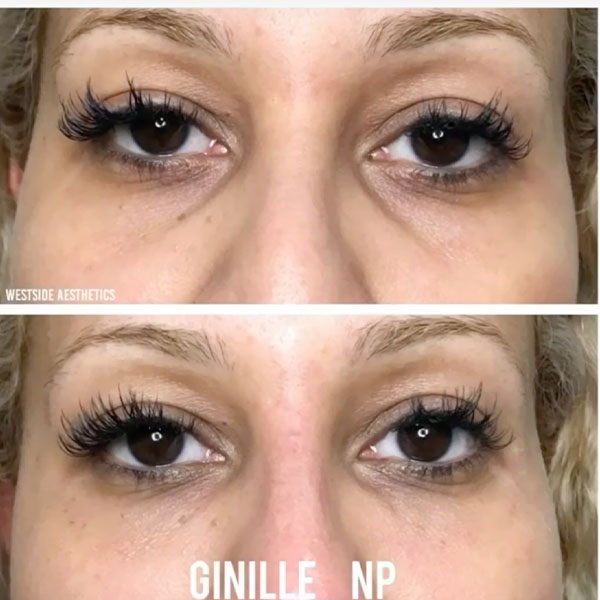 under eye injectables in Los Angeles