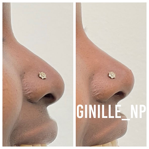 Non-surgical-Nose-Job-17-1