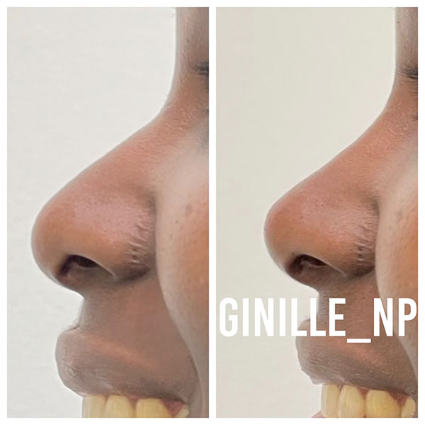 Non-surgical-Nose-Job-17-2