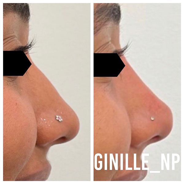 Non-surgical-Nose-Job,-Chin-Filler,-Under-Eye-Filler,-Lip-Filler-3