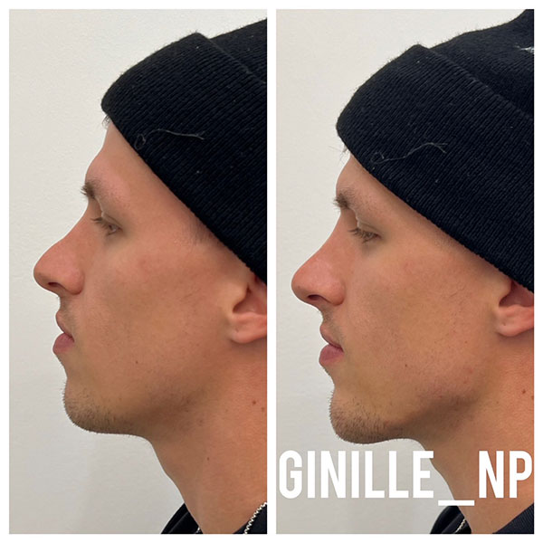 Non-surgical-Nose-Job,-Jawline-Enhancement,-Chin-Filler-1