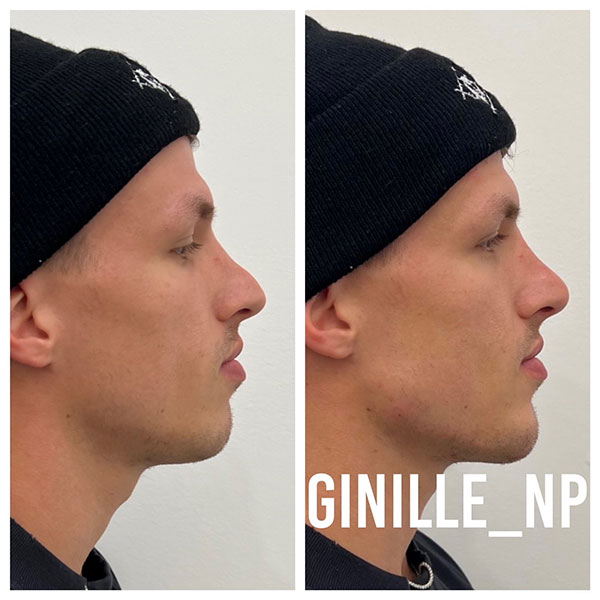 Non-surgical-Nose-Job,-Jawline-Enhancement,-Chin-Filler-2