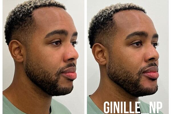 jawline-chin-9-4 jawline-chin-9-4